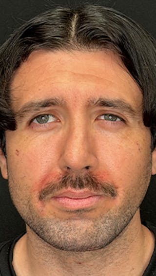 Mandibular Angle Implants Before & After Gallery - Patient 414857 - Image 6