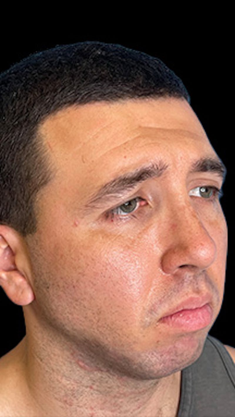 Mandibular Angle Implants Before & After Gallery - Patient 414857 - Image 7