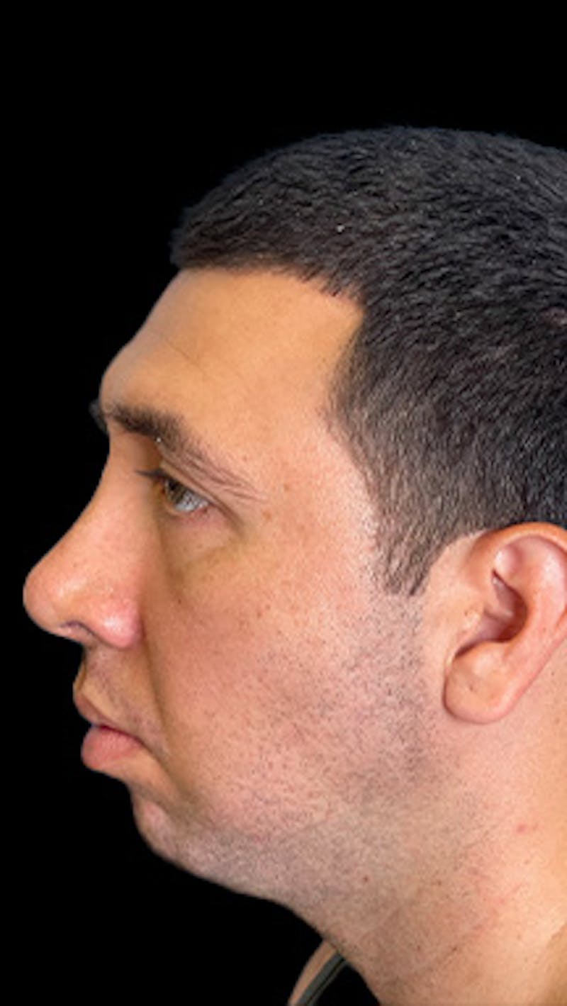 Mandibular Angle Implants Before & After Gallery - Patient 414857 - Image 1