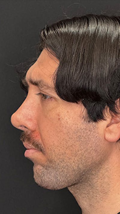 Mandibular Angle Implants Before & After Gallery - Patient 414857 - Image 2