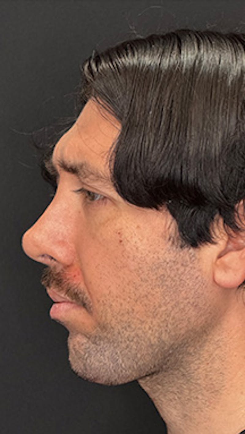 Mandibular Angle Implants Before & After Gallery - Patient 414857 - Image 2