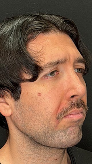 Mandibular Angle Implants Before & After Gallery - Patient 414857 - Image 8