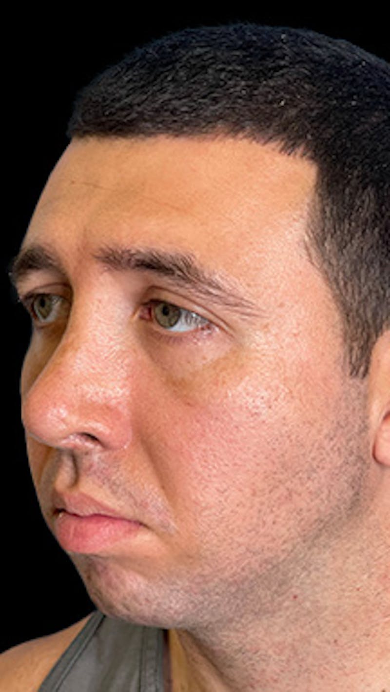 Mandibular Angle Implants Before & After Gallery - Patient 414857 - Image 3