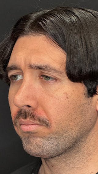 Mandibular Angle Implants Before & After Gallery - Patient 414857 - Image 4