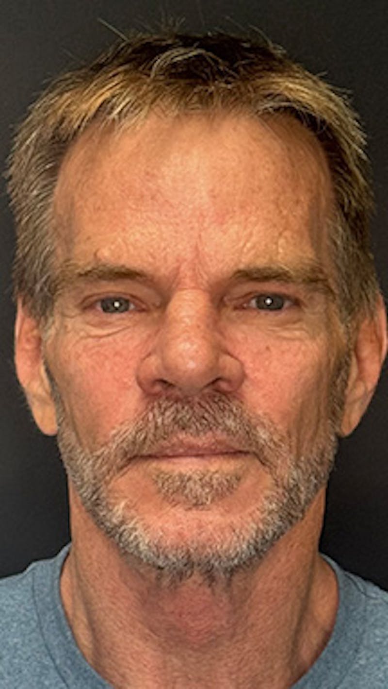 Lower Eye Rejuvenation Before & After Gallery - Patient 253410 - Image 1