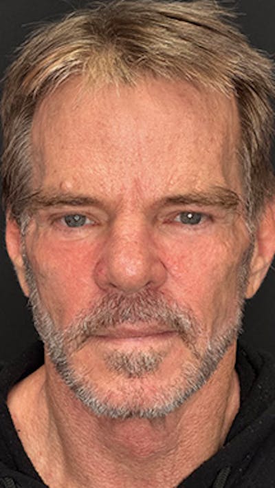 Lower Eye Rejuvenation Before & After Gallery - Patient 253410 - Image 2