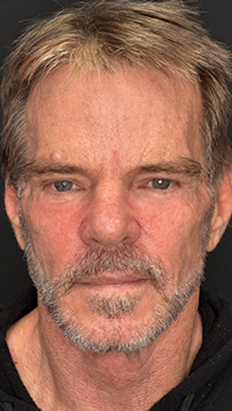 Lower Eye Rejuvenation Before & After Gallery - Patient 253410 - Image 2