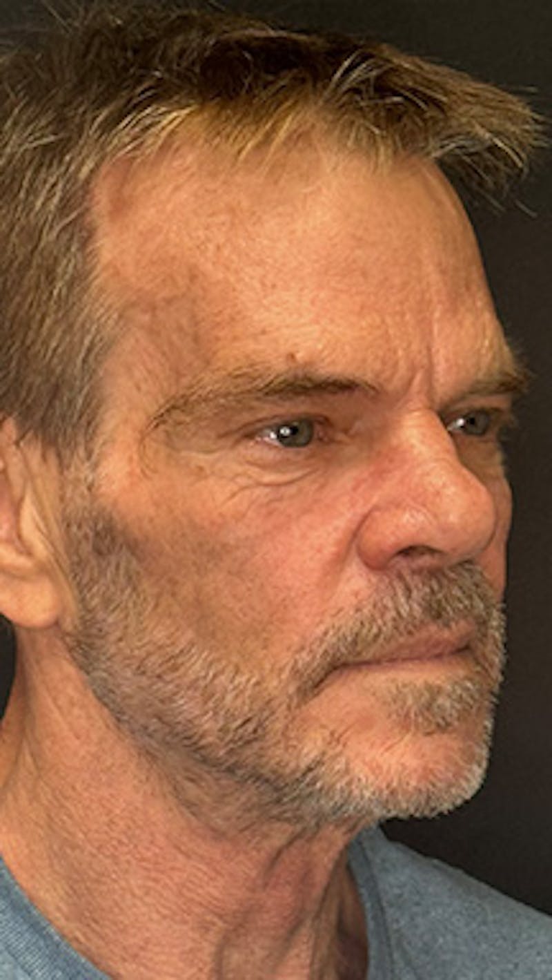 Lower Eye Rejuvenation Before & After Gallery - Patient 253410 - Image 3