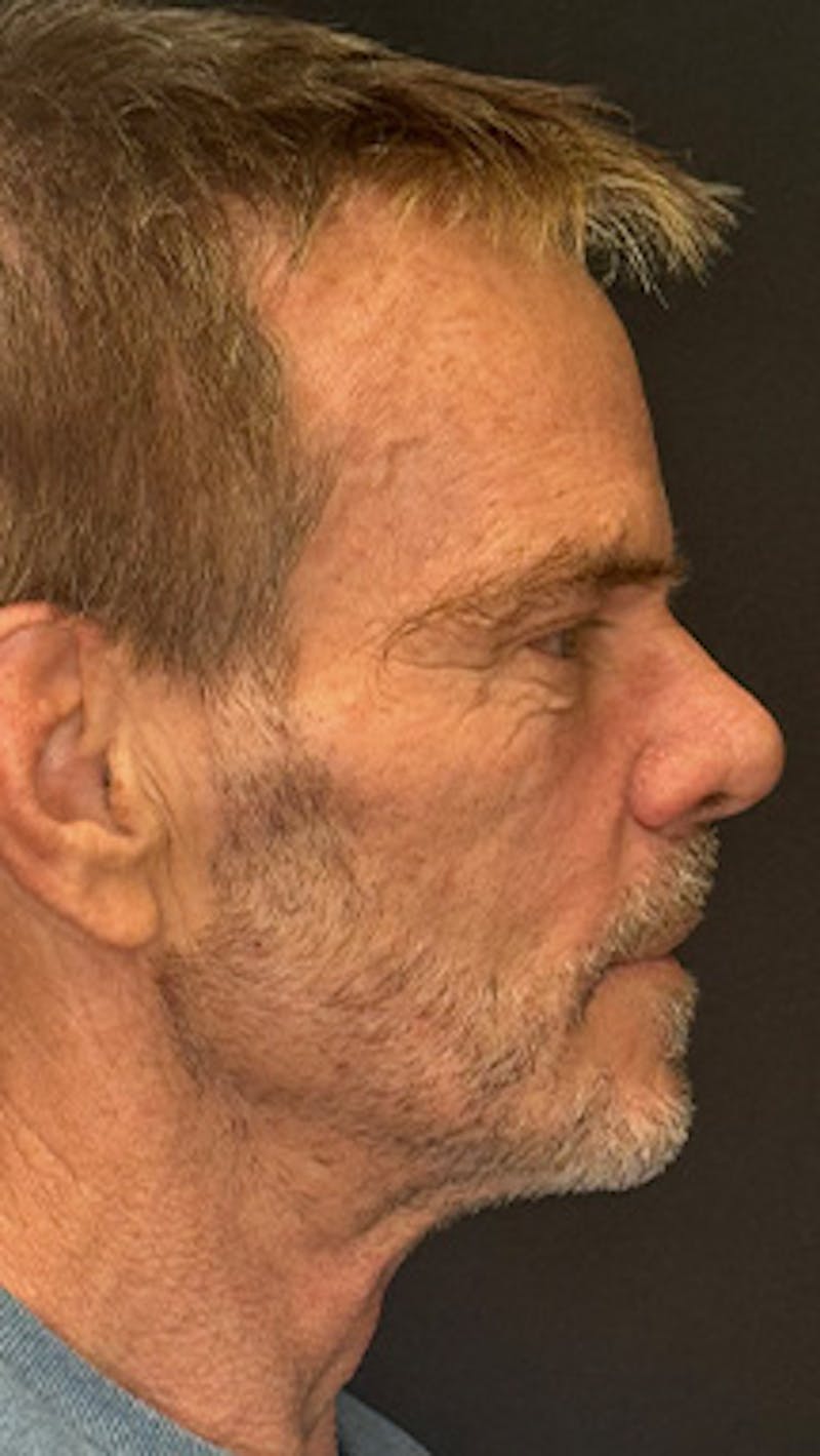 Lower Eye Rejuvenation Before & After Gallery - Patient 253410 - Image 5