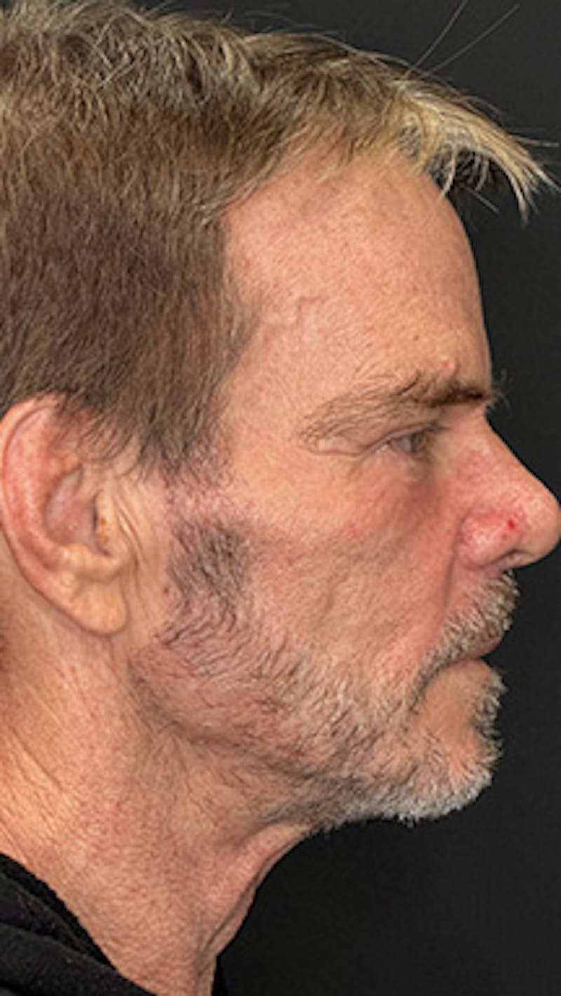 Lower Eye Rejuvenation Before & After Gallery - Patient 253410 - Image 6