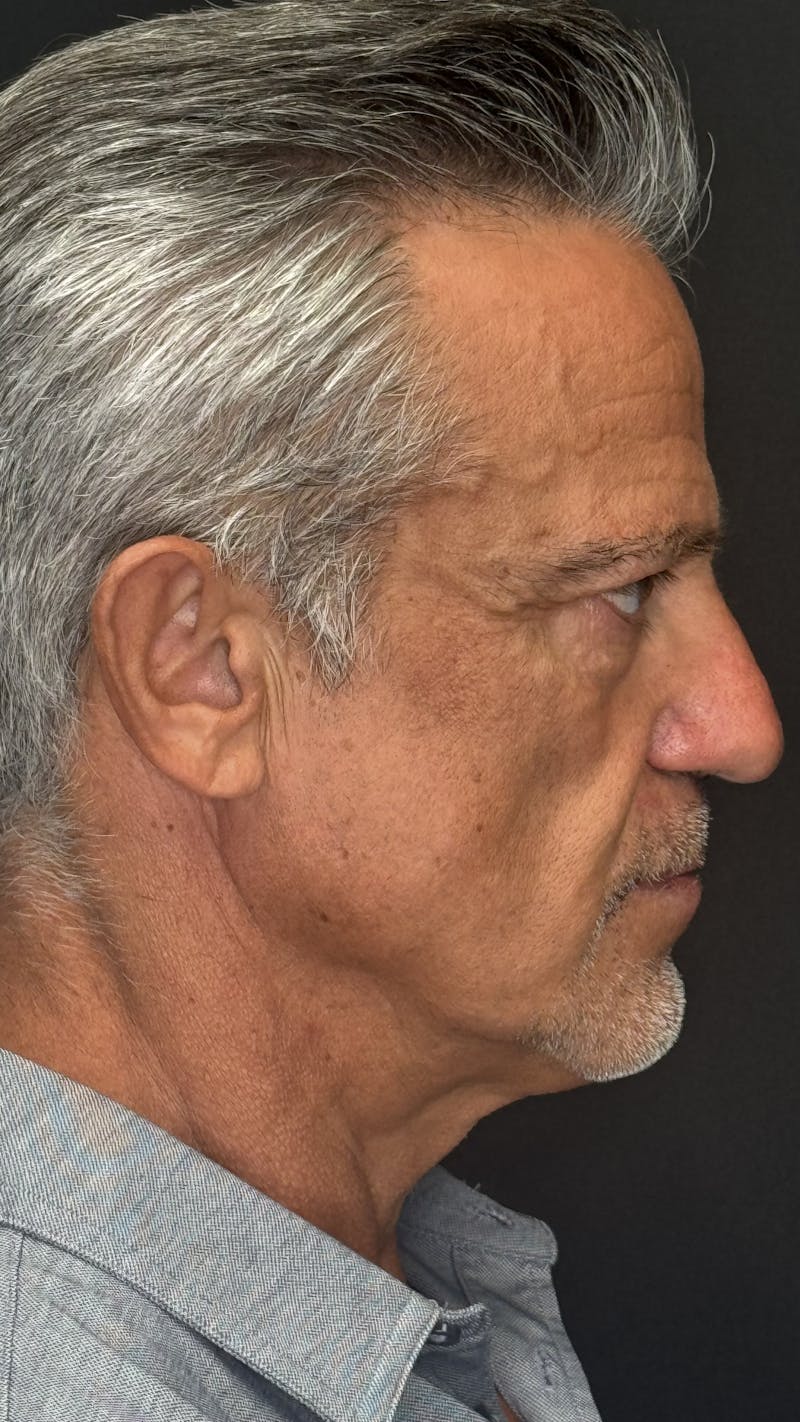 Chin Implant Before & After Gallery - Patient 398414 - Image 10