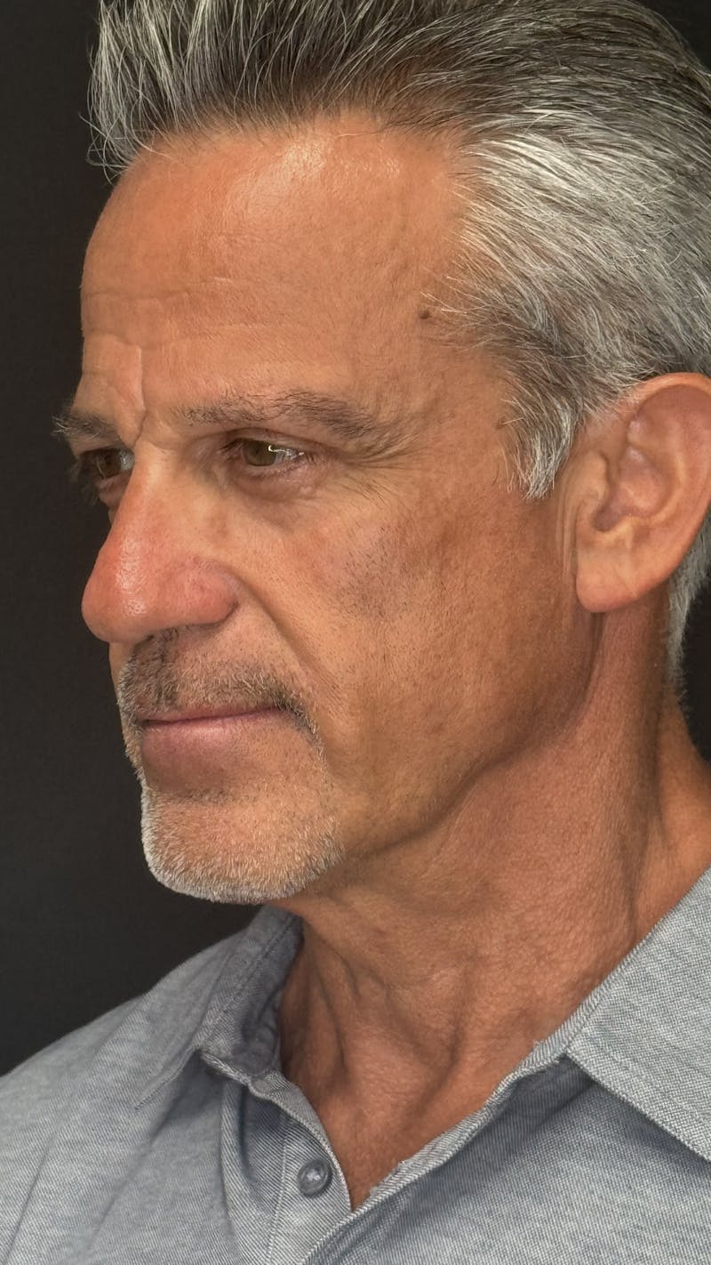 Chin Implant Before & After Gallery - Patient 398414 - Image 4