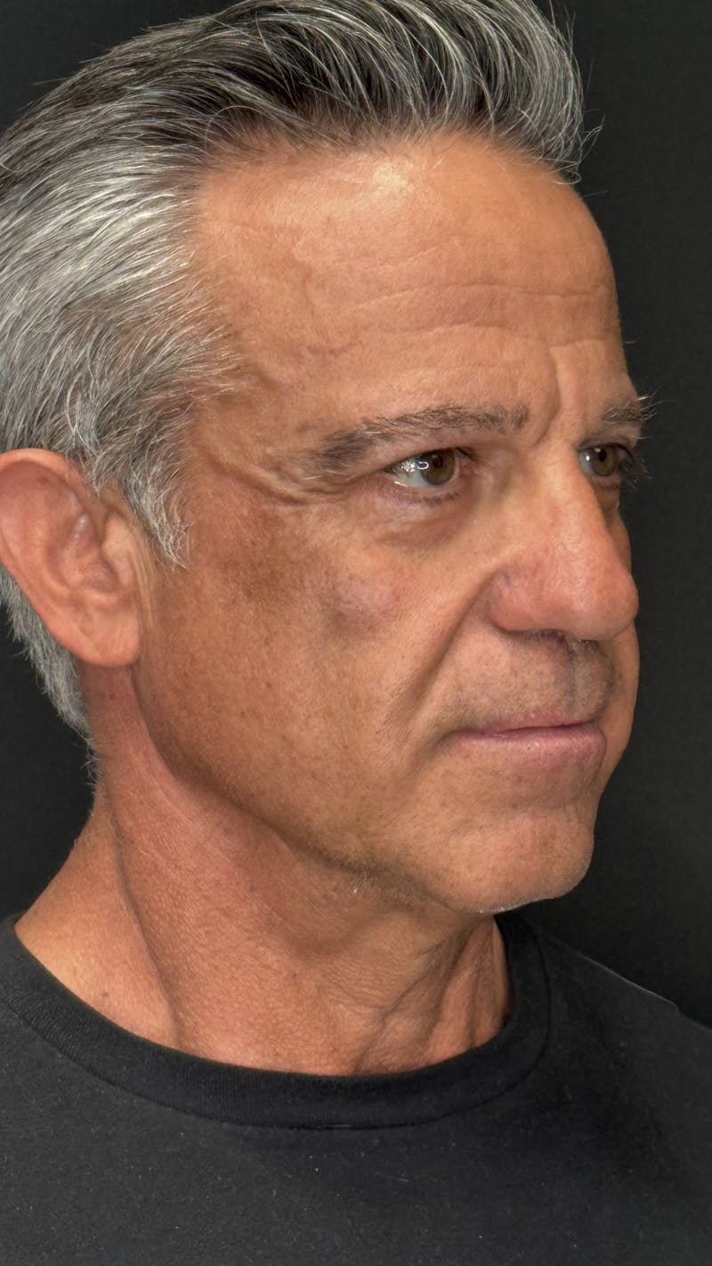 Chin Implant Before & After Gallery - Patient 398414 - Image 7