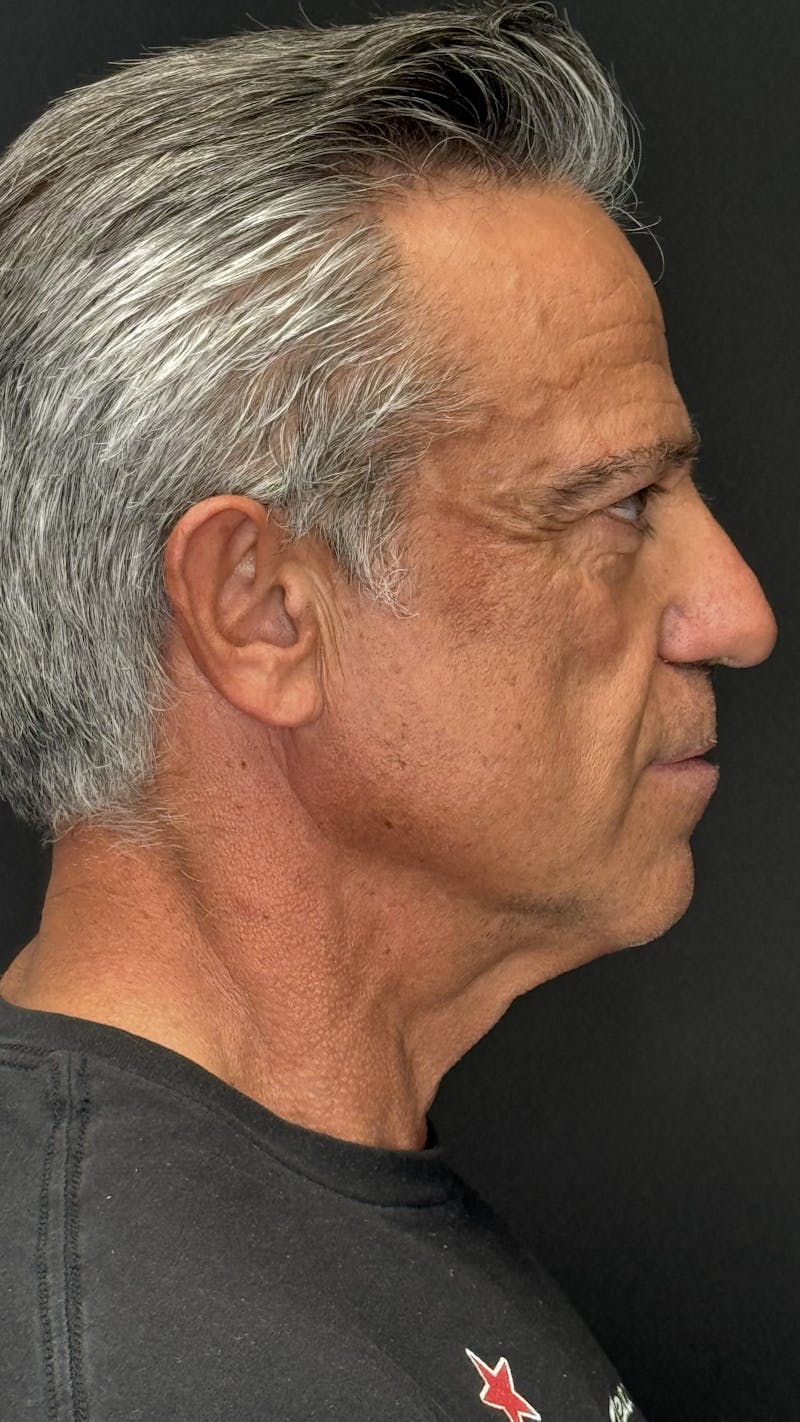 Chin Implant Before & After Gallery - Patient 398414 - Image 9