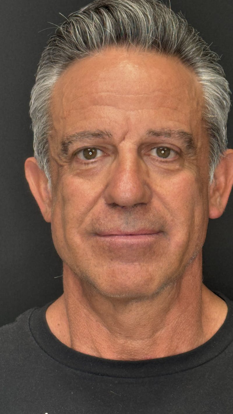 Chin Implant Before & After Gallery - Patient 398414 - Image 1