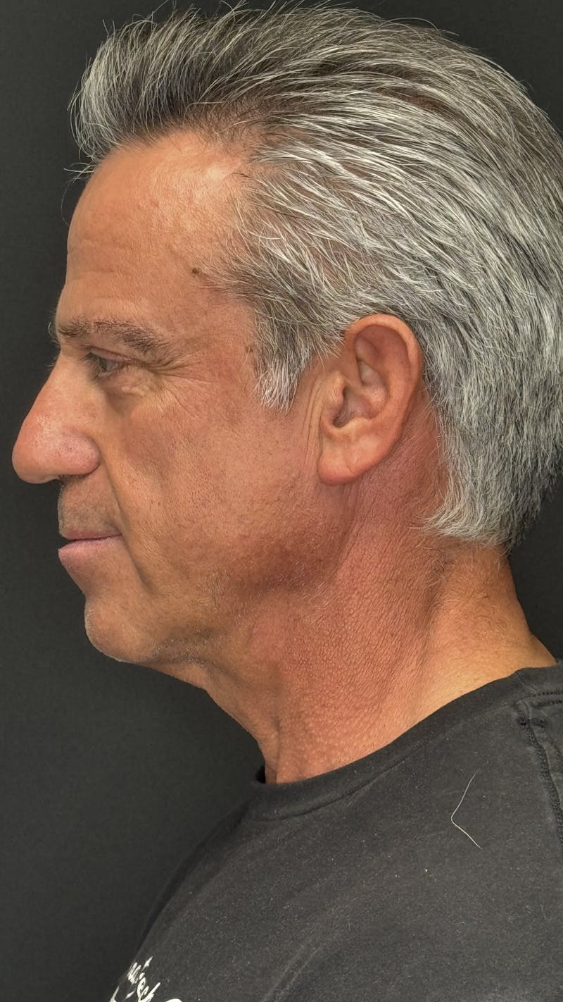 Chin Implant Before & After Gallery - Patient 398414 - Image 5