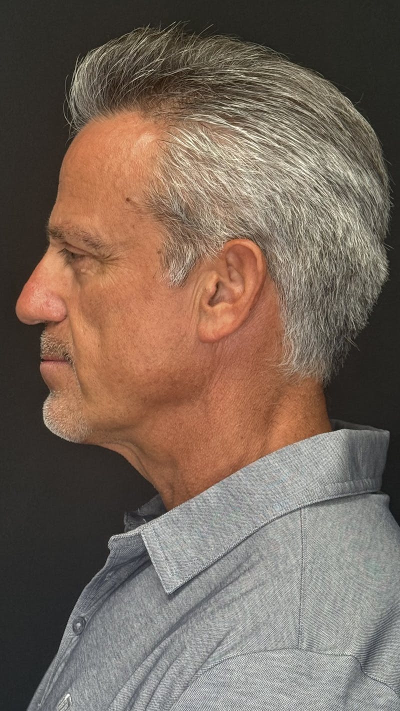 Chin Implant Before & After Gallery - Patient 398414 - Image 6