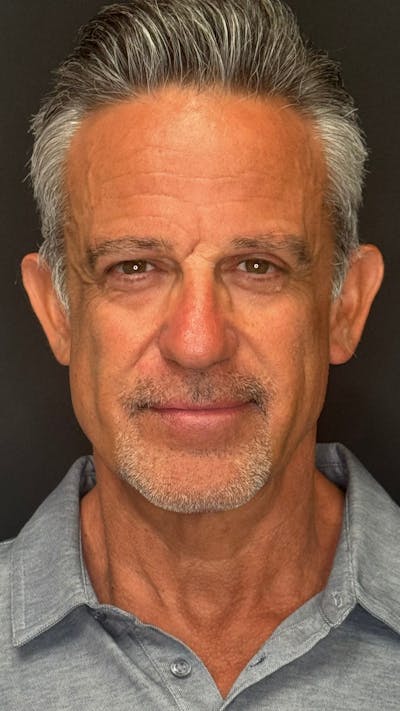 Chin Implant Before & After Gallery - Patient 398414 - Image 2