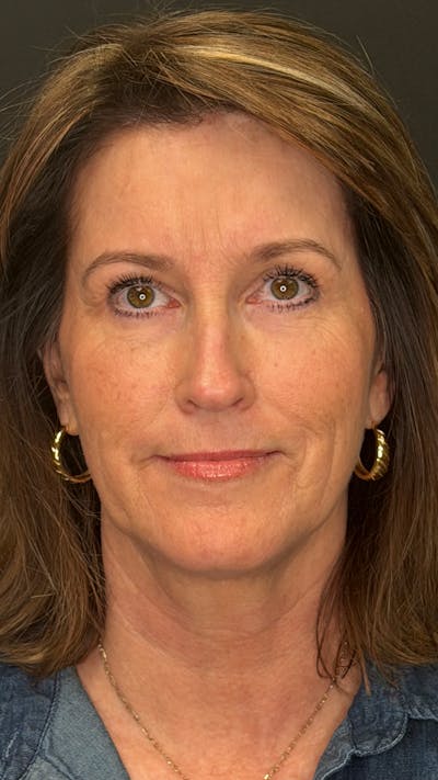 Lower Eye Rejuvenation Before & After Gallery - Patient 371365 - Image 2