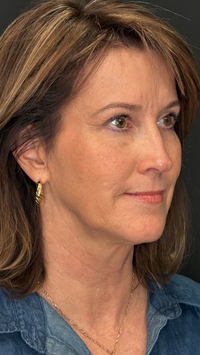 Upper Eye Rejuvenation Before & After Gallery - Patient 159289 - Image 2