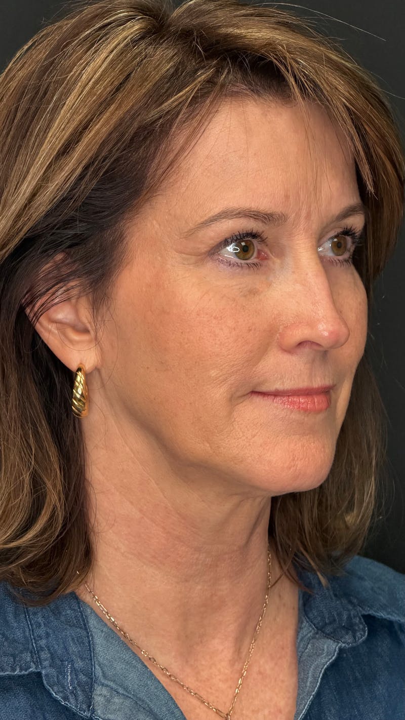 Upper Eye Rejuvenation Before & After Gallery - Patient 159289 - Image 2