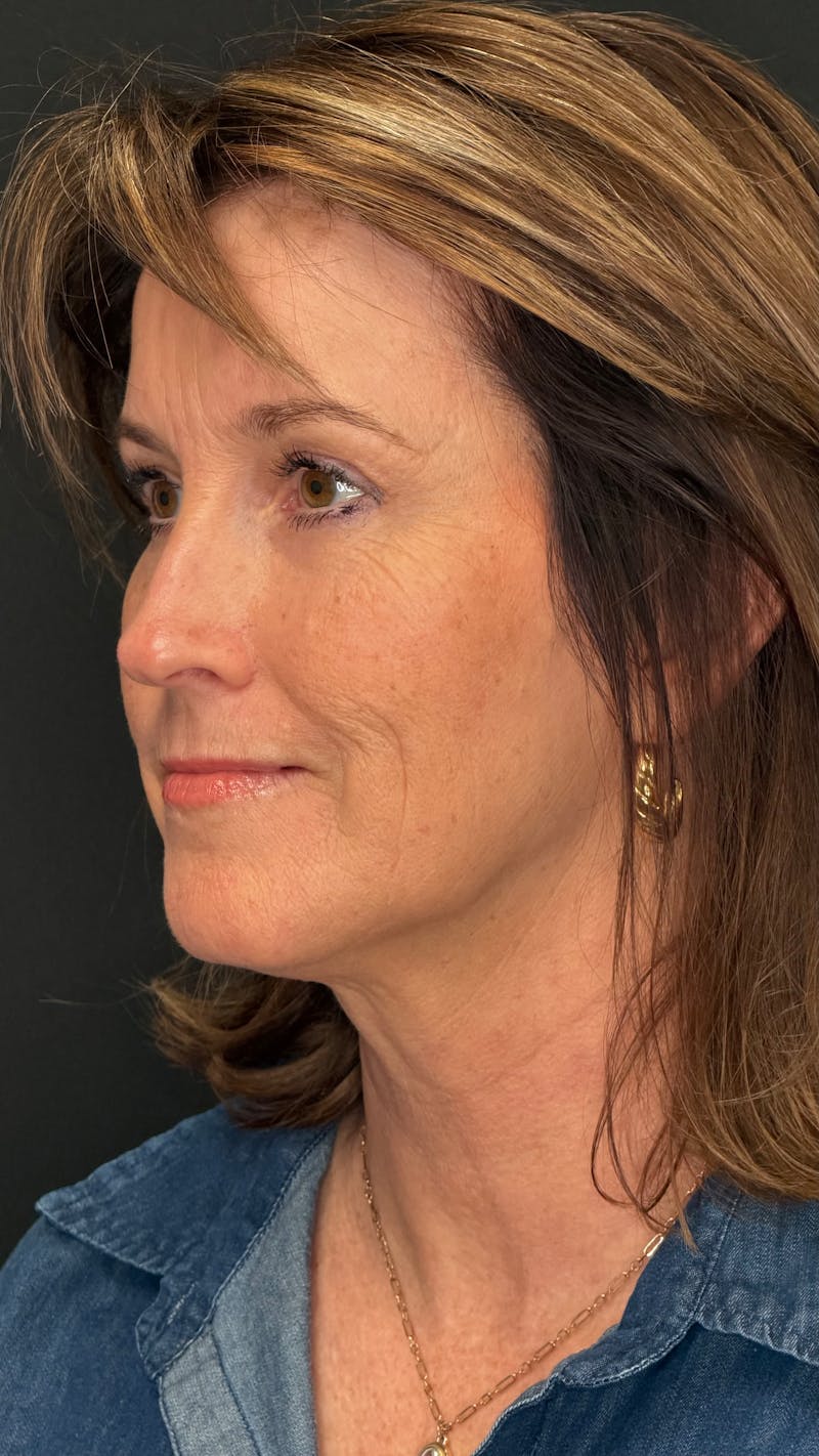 Upper Eye Rejuvenation Before & After Gallery - Patient 159289 - Image 6