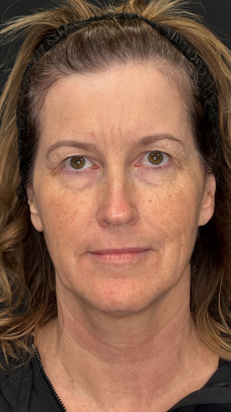 Upper Eye Rejuvenation Before & After Gallery - Patient 159289 - Image 3