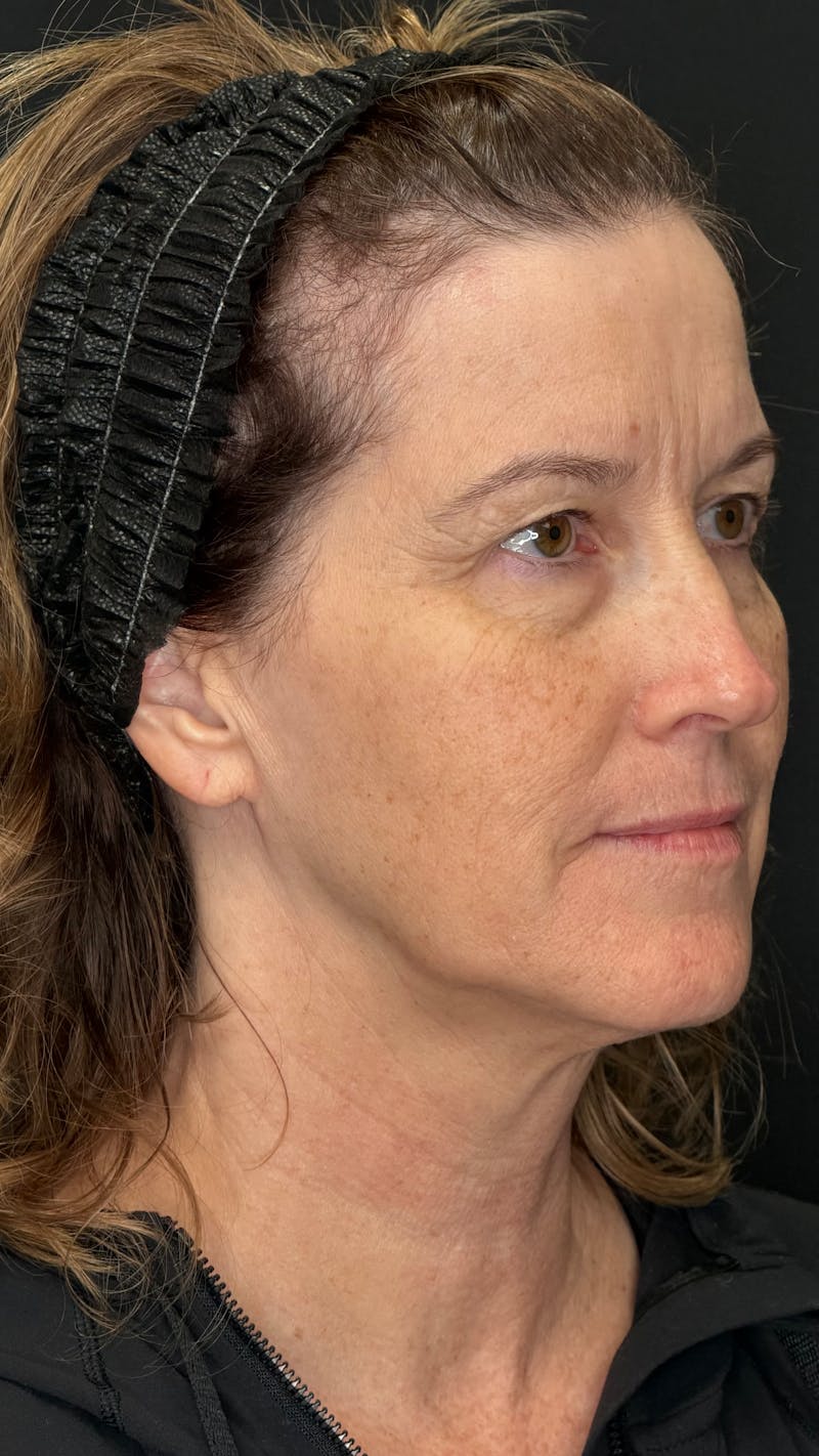 Upper Eye Rejuvenation Before & After Gallery - Patient 159289 - Image 1