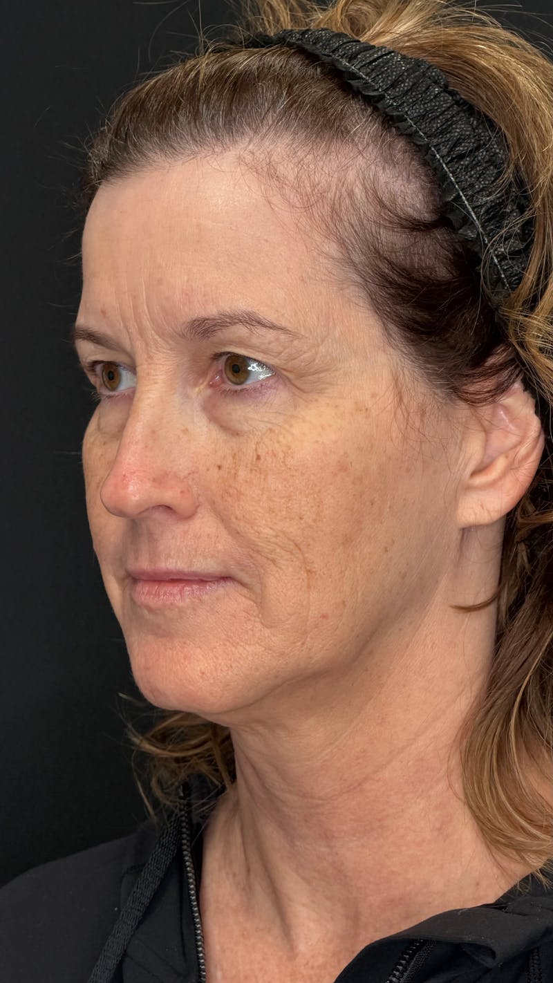 Upper Eye Rejuvenation Before & After Gallery - Patient 159289 - Image 5