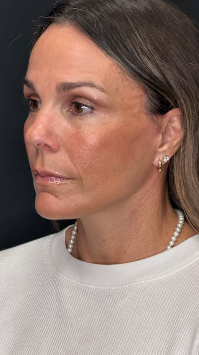 Mini Deep Plane Facelift Before & After Gallery - Patient 224427 - Image 2