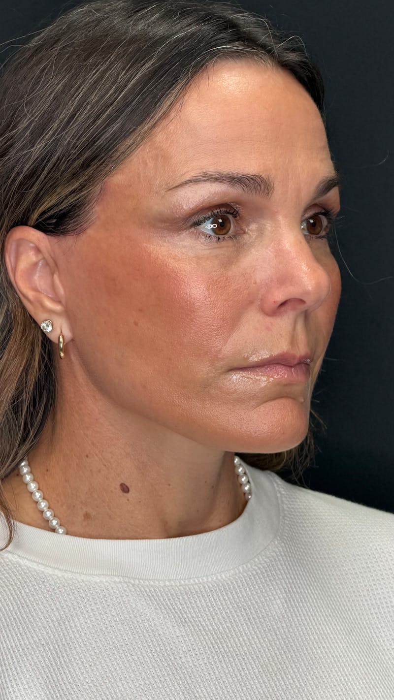 Deep Plane Facelift 40s Before & After Gallery - Patient 687387 - Image 2