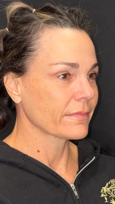 Deep Plane Facelift 40s Before & After Gallery - Patient 687387 - Image 1