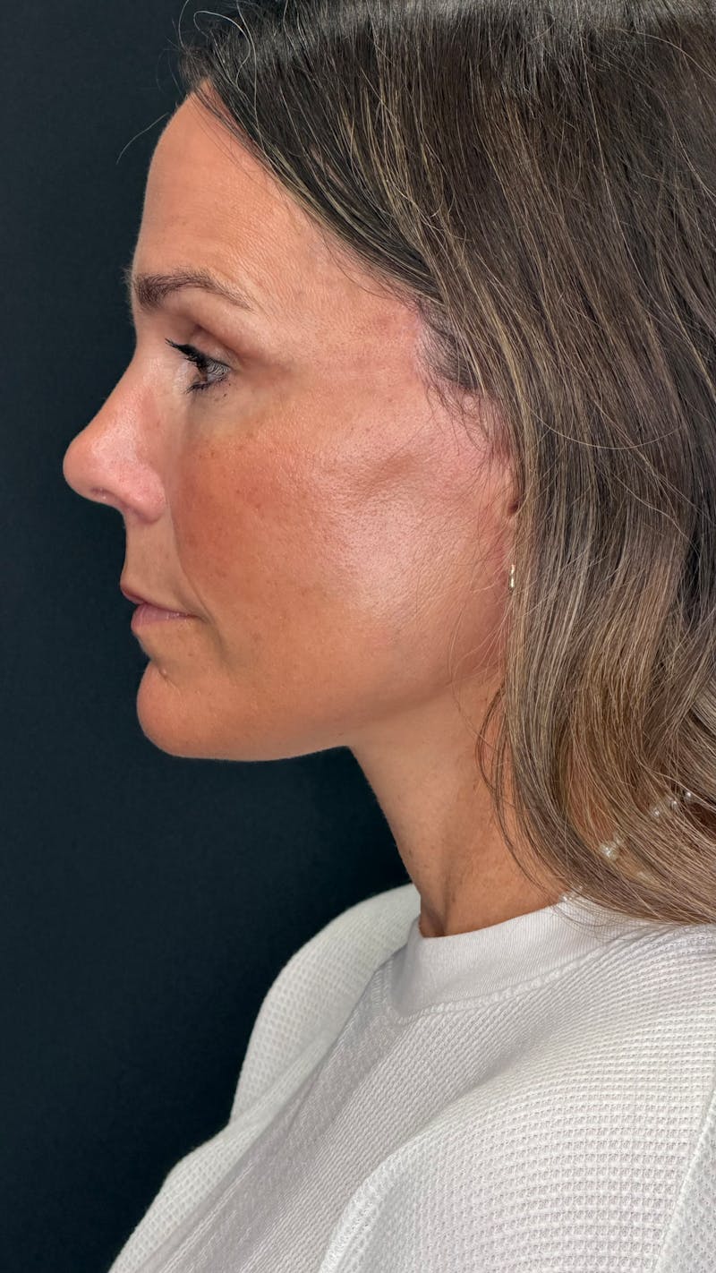 Deep Plane Facelift 40s Before & After Gallery - Patient 687387 - Image 10