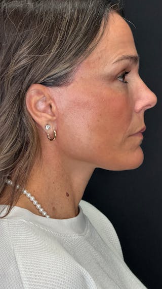 Deep Plane Facelift 40s Before & After Gallery - Patient 687387 - Image 4
