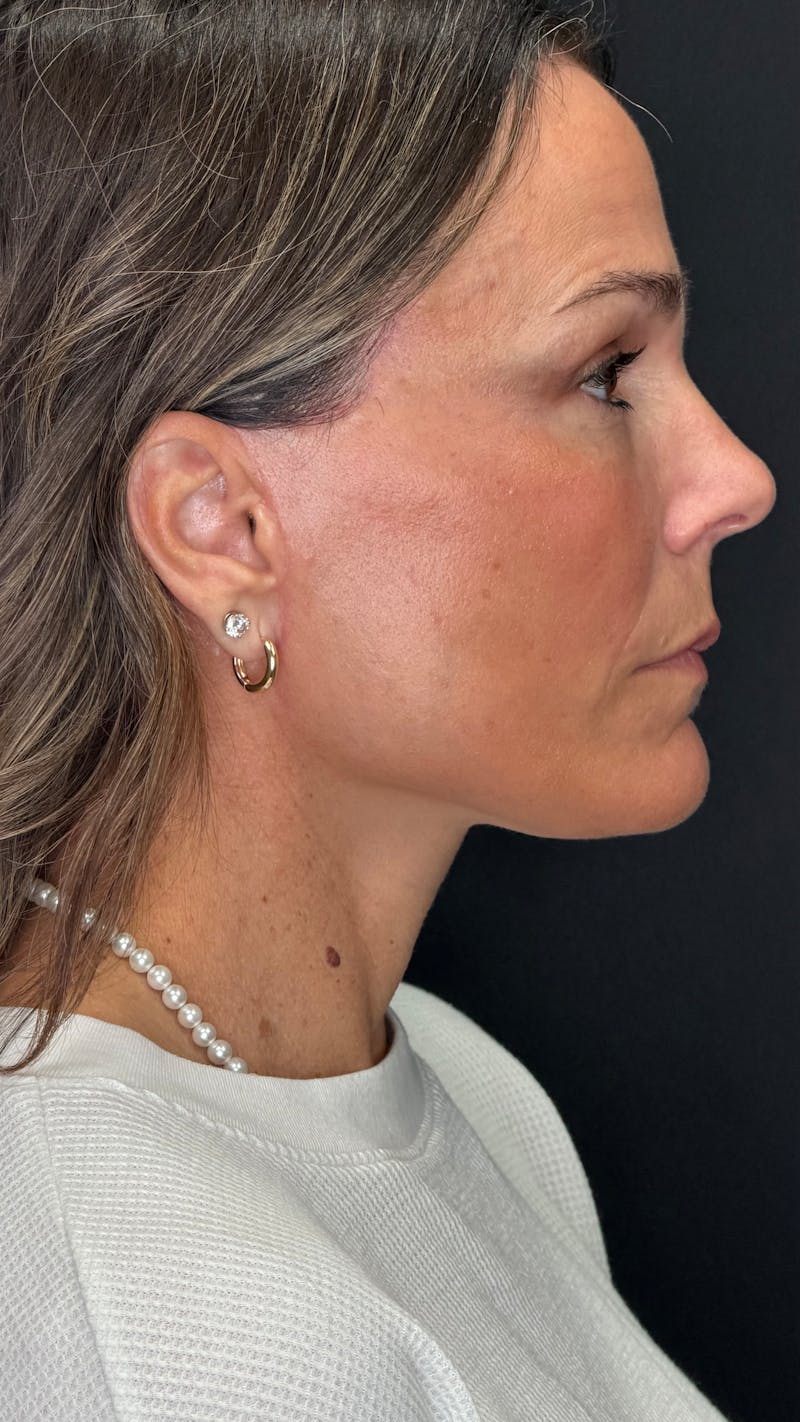 Deep Plane Facelift 40s Before & After Gallery - Patient 687387 - Image 4