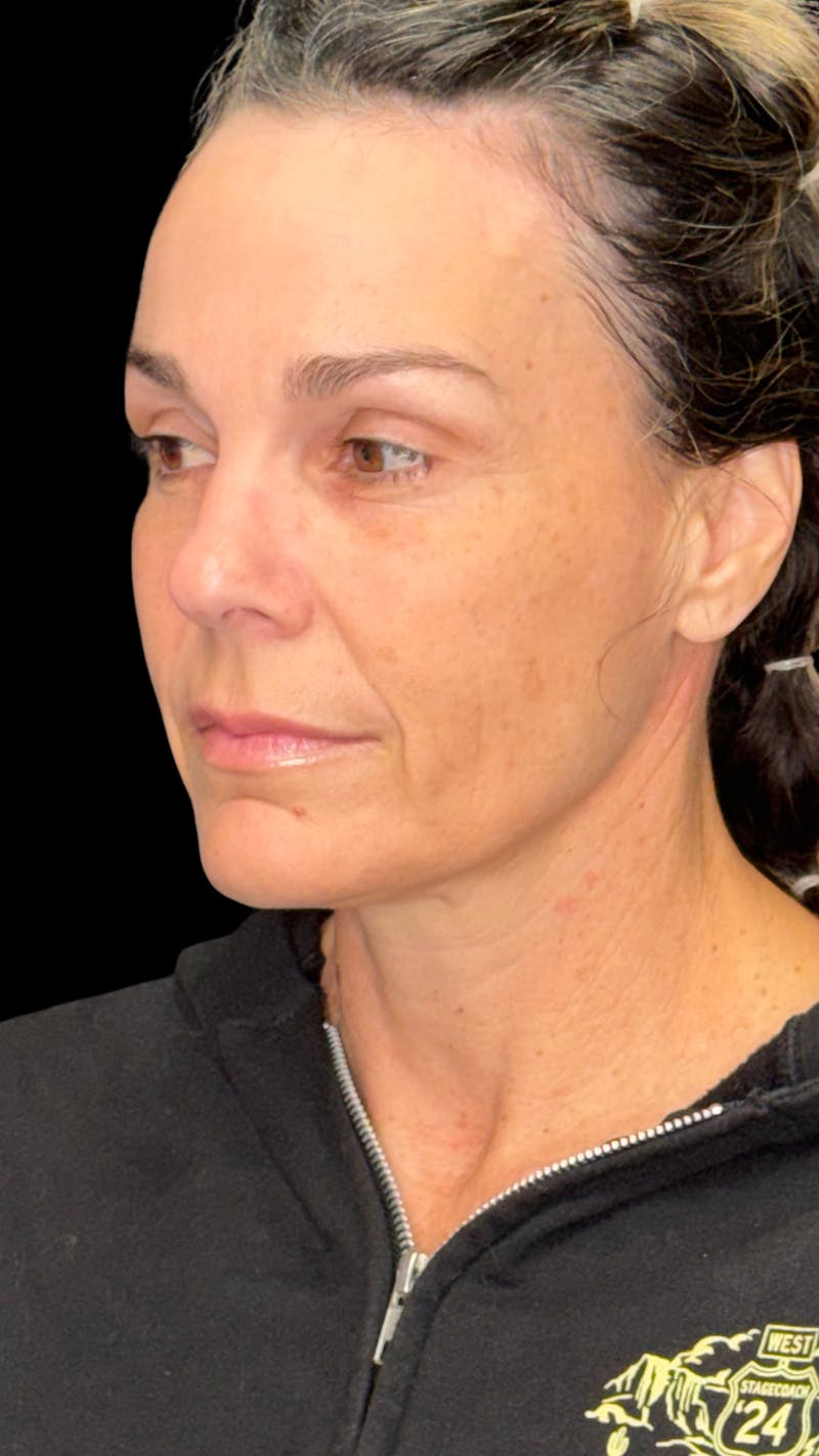Deep Plane Facelift 40s Before & After Gallery - Patient 687387 - Image 5