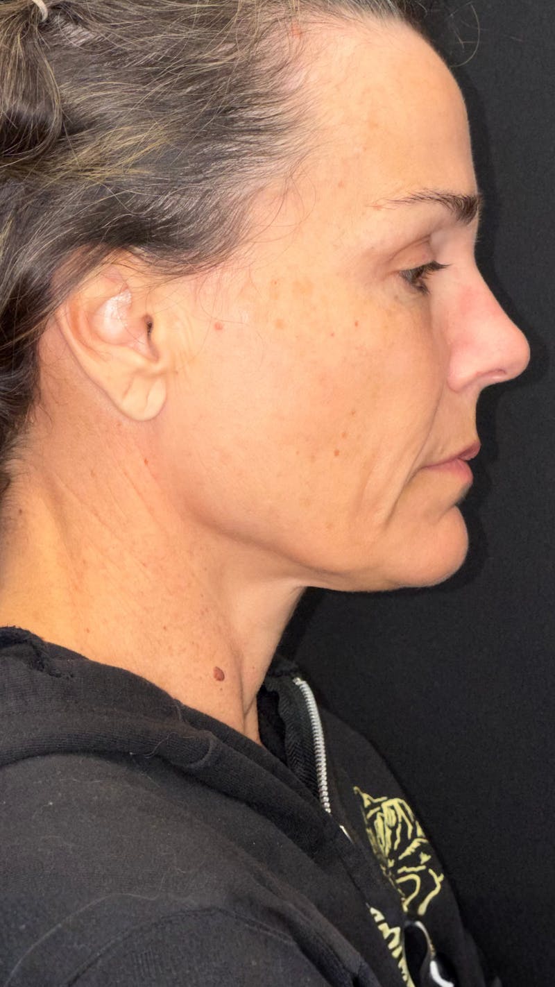 Deep Plane Facelift 40s Before & After Gallery - Patient 687387 - Image 3