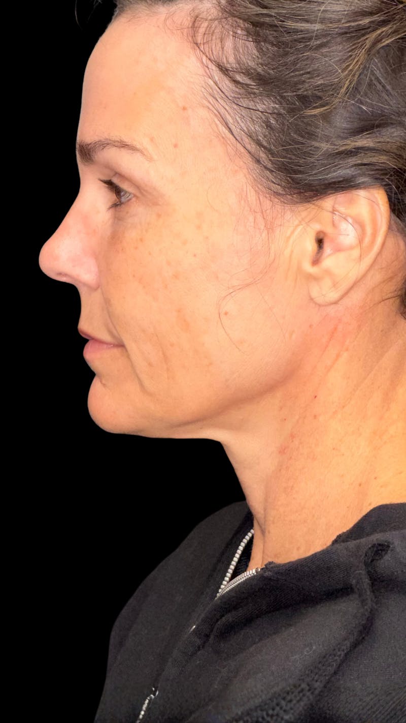 Deep Plane Facelift 40s Before & After Gallery - Patient 687387 - Image 9