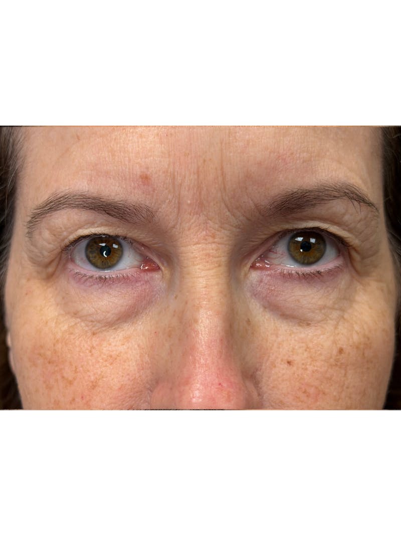 Upper Eye Rejuvenation Before & After Gallery - Patient 159289 - Image 7