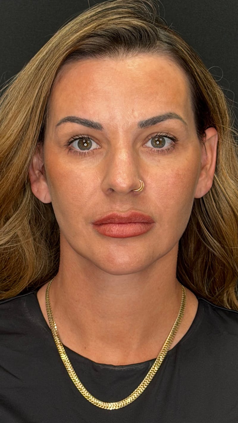 Deep Plane Facelift 40s Before & After Gallery - Patient 419328 - Image 2