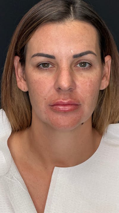 Deep Plane Facelift 40s Before & After Gallery - Patient 419328 - Image 1