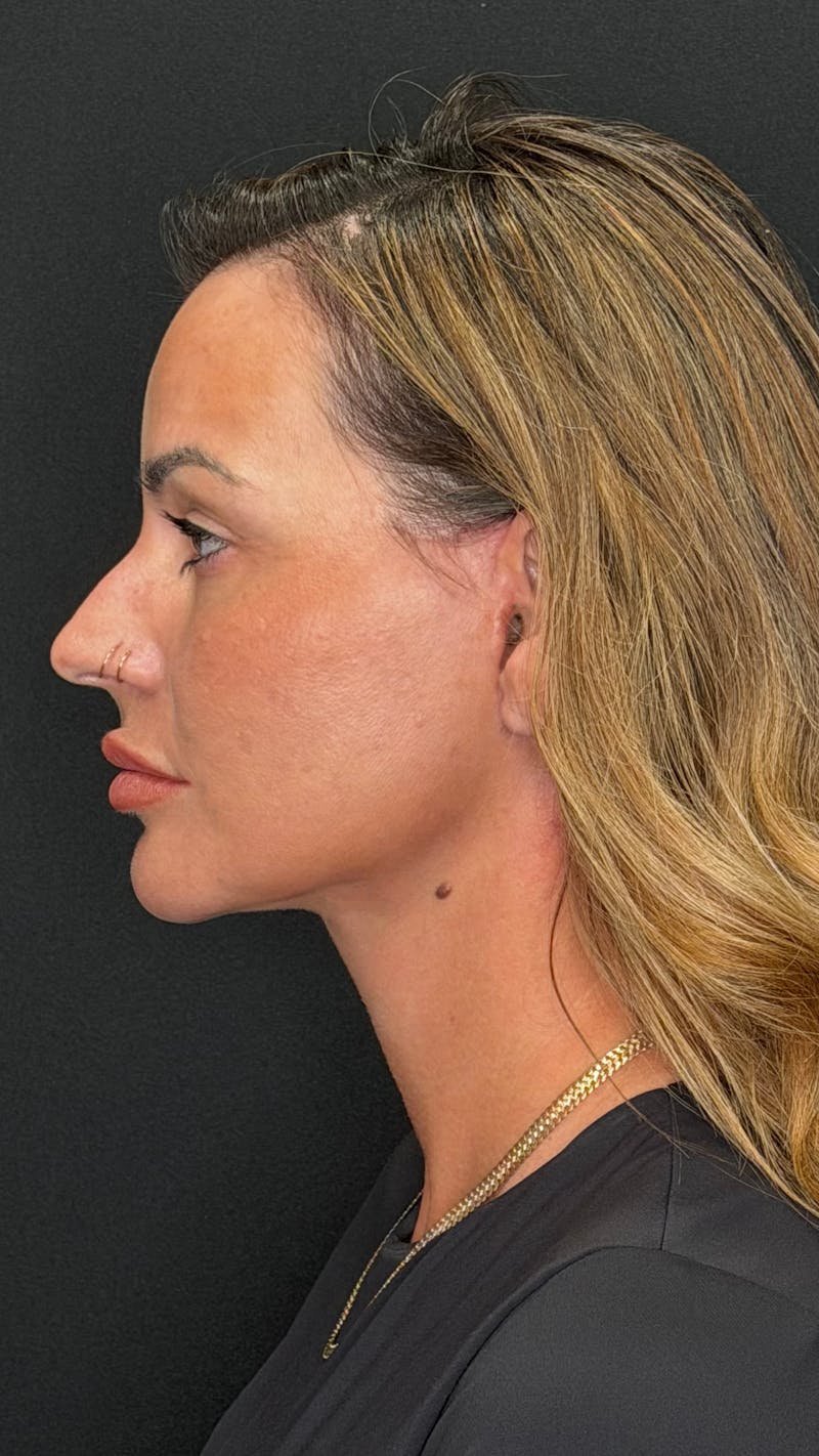 Deep Plane Facelift 40s Before & After Gallery - Patient 419328 - Image 6