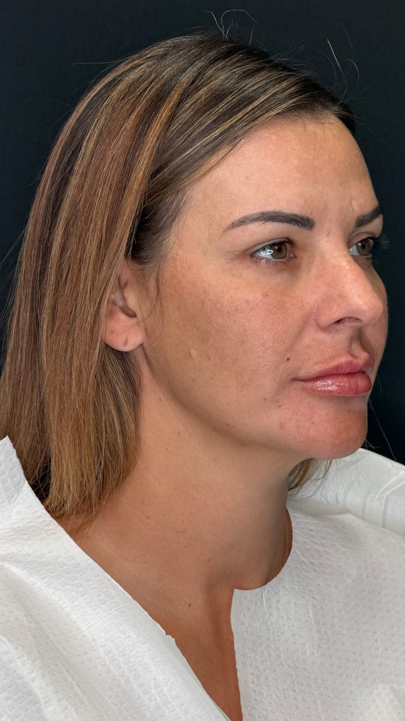 Deep Plane Facelift 40s Before & After Gallery - Patient 419328 - Image 7