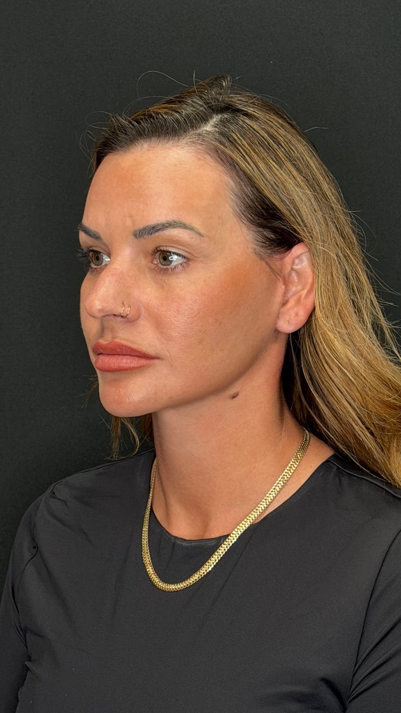 Deep Plane Facelift 40s Before & After Gallery - Patient 419328 - Image 4