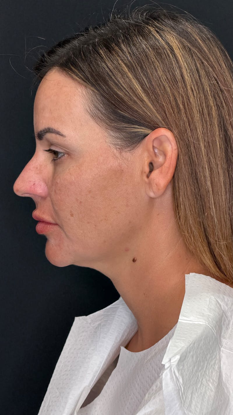 Deep Plane Facelift 40s Before & After Gallery - Patient 419328 - Image 5