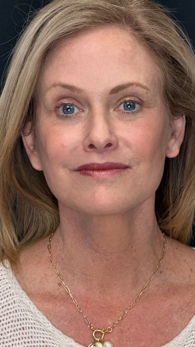 ContourLift Before & After Gallery - Patient 838284 - Image 2