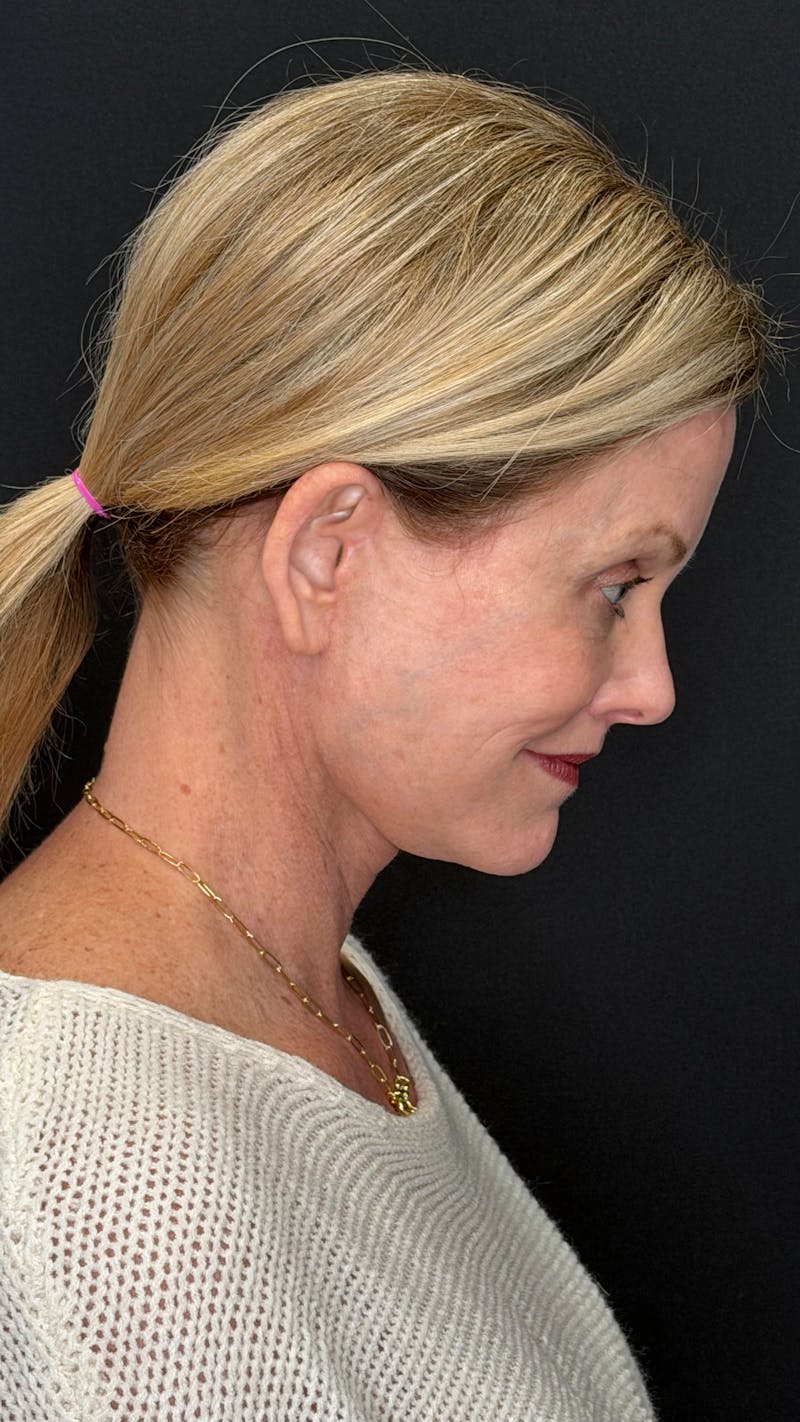 Deep Plane Facelift 50s Before & After Gallery - Patient 334108 - Image 10