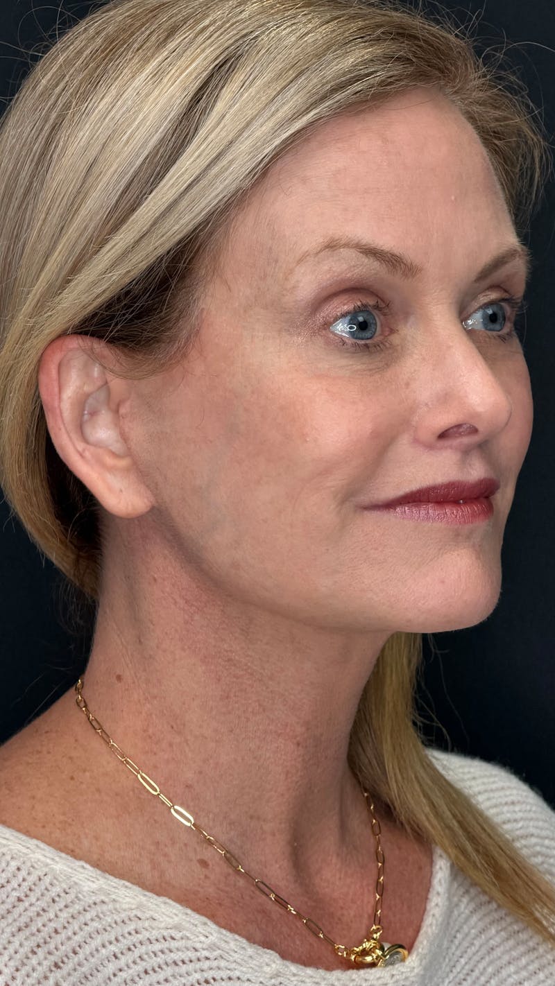 Deep Plane Facelift 50s Before & After Gallery - Patient 334108 - Image 4