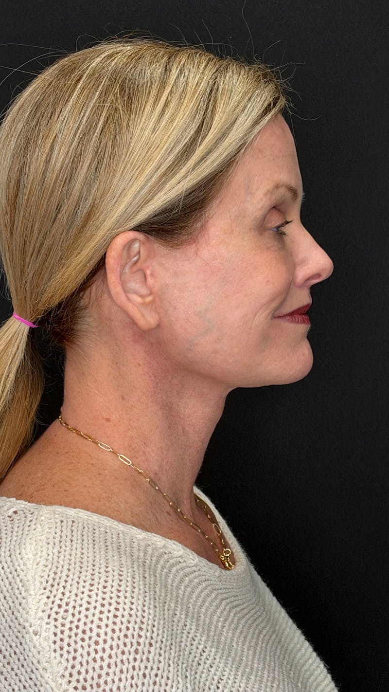 Deep Plane Facelift 50s Before & After Gallery - Patient 334108 - Image 8