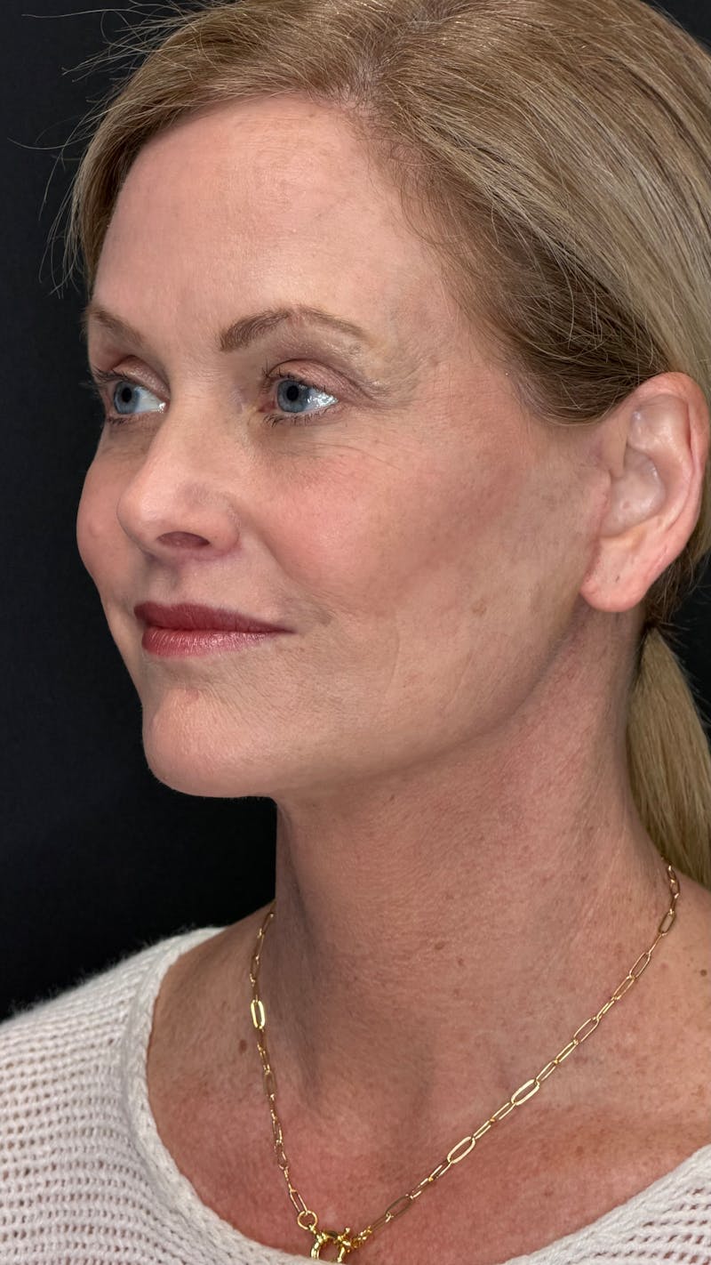 Deep Plane Facelift 50s Before & After Gallery - Patient 334108 - Image 6